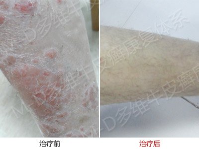 儿童如何有效的预防牛皮癣