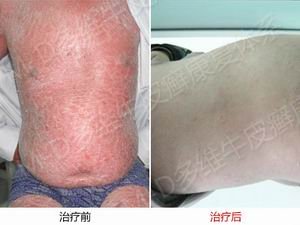 银屑病典型损害有哪些