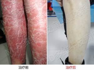 银屑病的晚期症状是怎样的呢