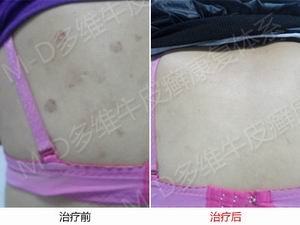 银屑病的发病前兆有哪些