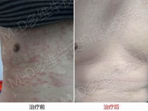 银屑病患者饮食上要注意什么