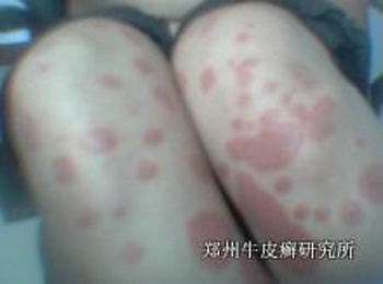 什么是牛皮癣的病因