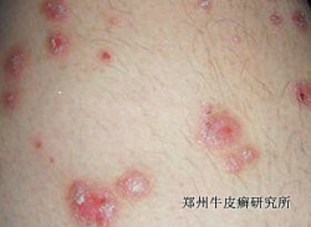 牛皮癣的发病原因